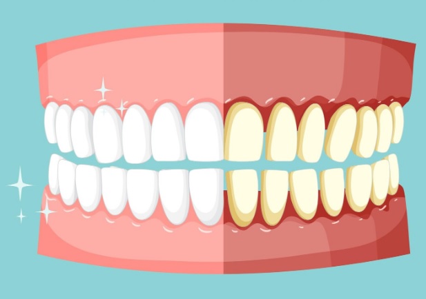 Na czym polega domowe wybielanie zębów i czym różni się od zabiegów wykonywanych w gabinecie?