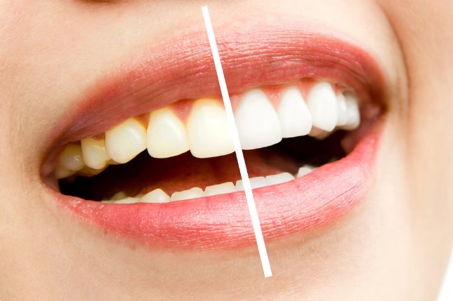 Jakie ograniczenia ma domowe wybielanie zębów w porównaniu z metodami gabinetowymi?